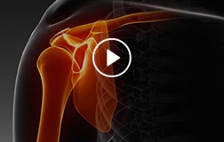 Patient Education Videos of J. Kristopher Ware, MD - Orthopedic Surgeon - Sports Medicine Specialist
